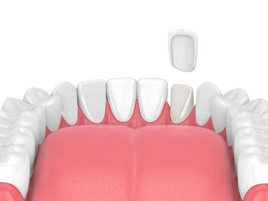 What To Do If Dental Veneers Come Off
