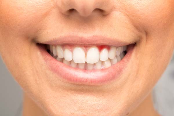 Preventive Dentistry Tips For Gum Disease